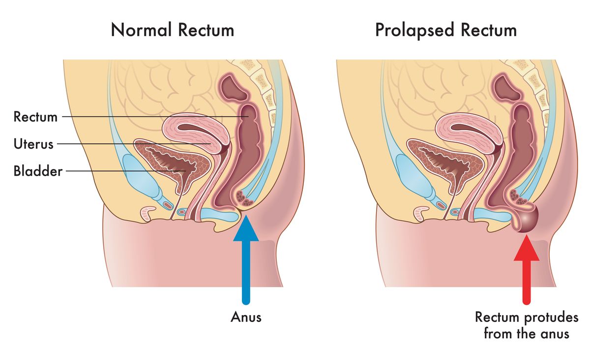 Rectal prolapse